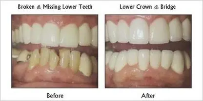 before and after dental crowns