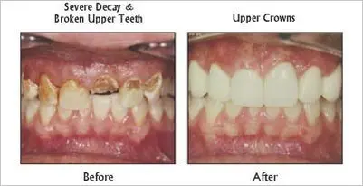 Upper Crowns before and after