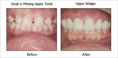 Upper Bridge before and after