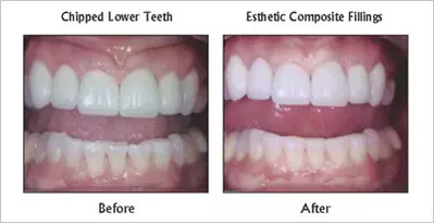 Esthetic Composite Fillings before and after