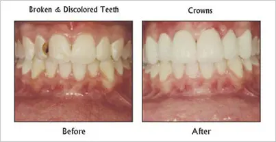 Crowns before and after