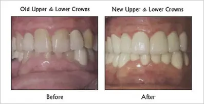 New Upper & Lower Crowns before and after