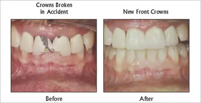 New Front Crowns before and after