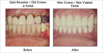 New Crowns / New Valplast Partial before and after