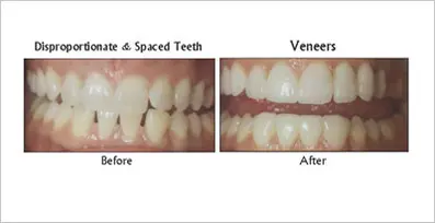Veneers before and after