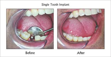 Single Tooth Implant before and after