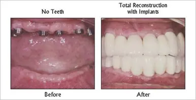 Total Reconstruction With Implants before and after