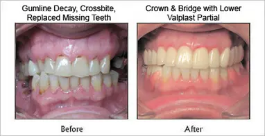 Crown & Bridge With Lower Valplast Partial before and after