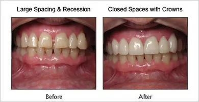 Crowns before and after