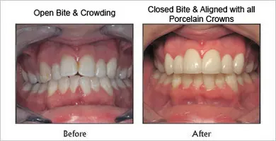 Closed Bite & Aligned With All Porcelain Crowns before and after