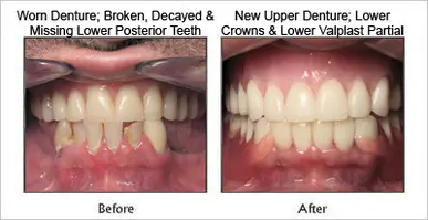 Crowns before and after