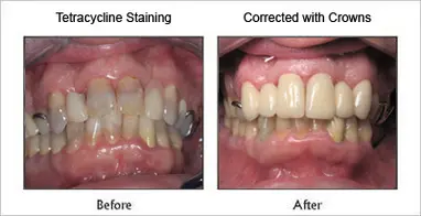 Corrected With Crowns before and after