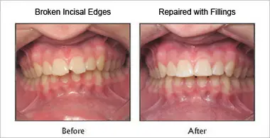 Filling before and after