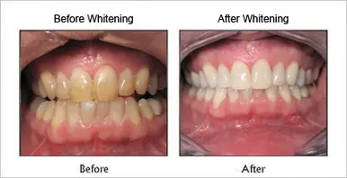 Teeth Whitening before & after