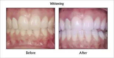 Teeth Whitening before and after