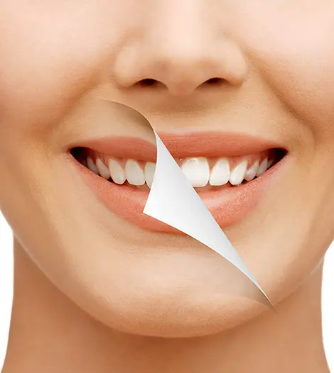 beautiful woman with white teeth before and after