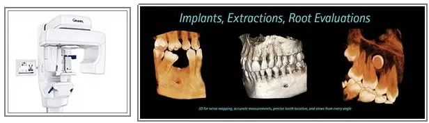 GXDP-700 Series 3d Scanner and example 3d scans of implants, extractions, and root evaluations